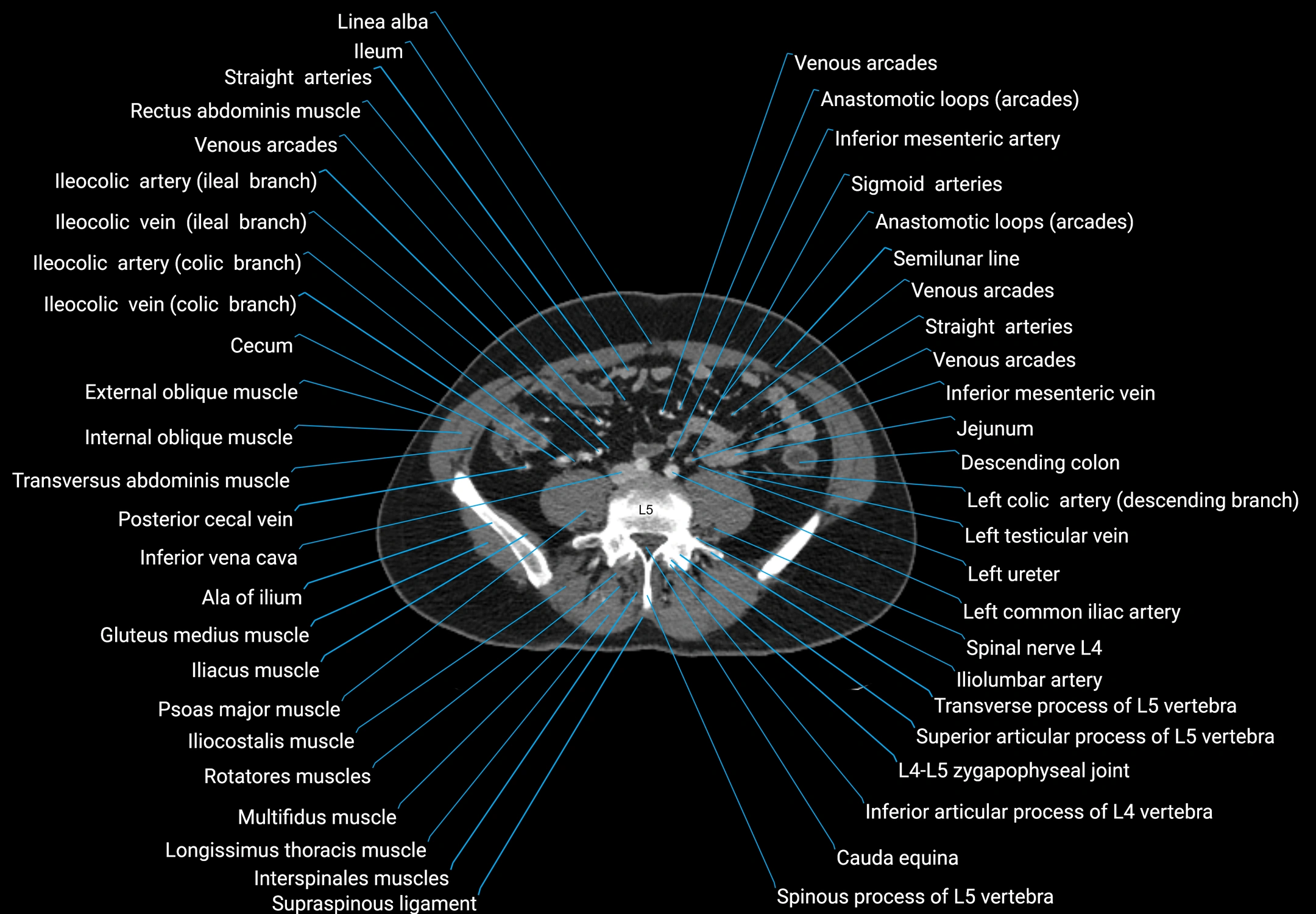 CT male pelvis axial cross sectional anatomy labelled radiology image -00121.webp